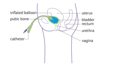 Female suprapubic catheter