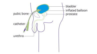 Male suprapubic catheter