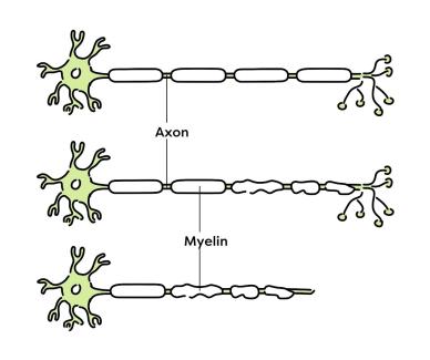 Diagram of healthy nerve cell and damaged nerve cell through demyelination