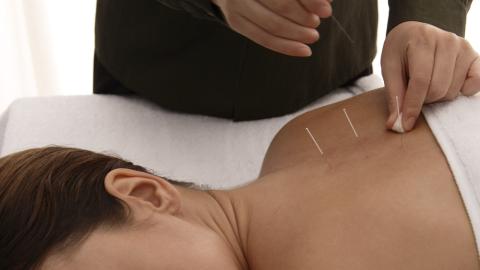 Woman receiving acupuncture