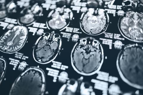 MRI scan images